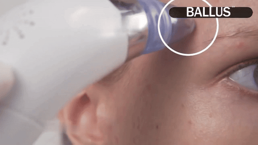 Blackhead Remover Vacuum Device for Clear Skin - Sywora